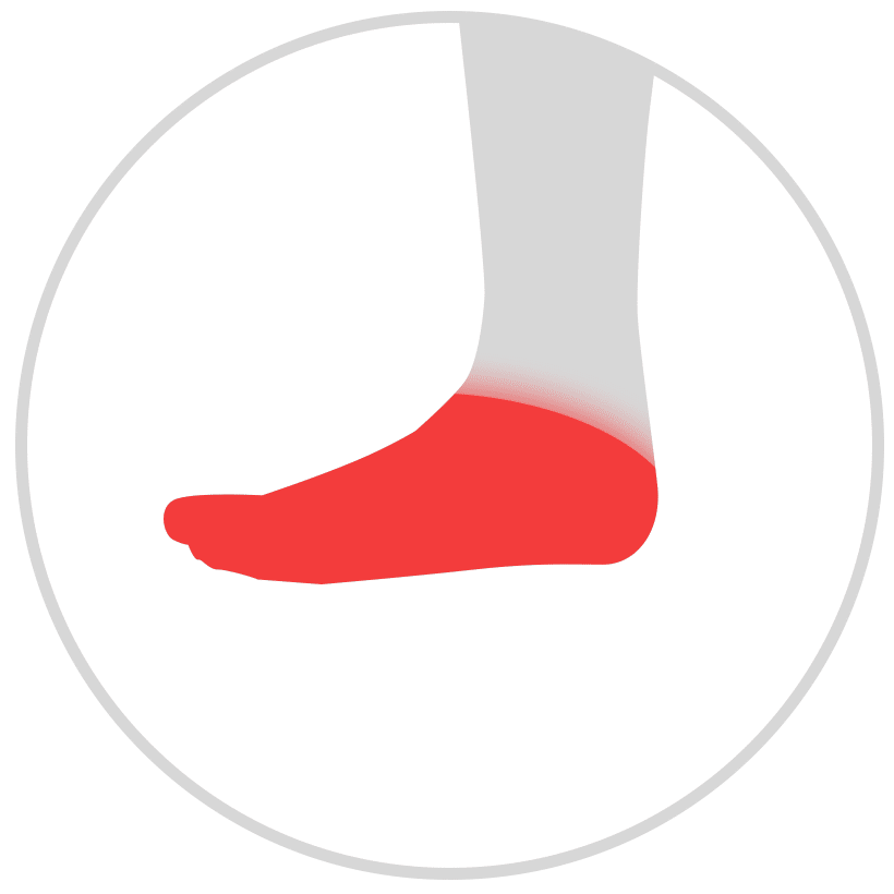 Flat Feet / High Arches - Northernhay Clinic